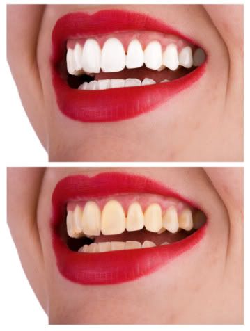 7 Kebiasaan Yang Dapat Merusak Gigi